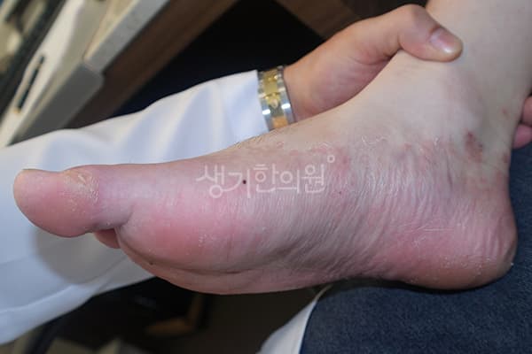 한포진 치료 전 사진 — 천안아산점, 치료 기간 4개월