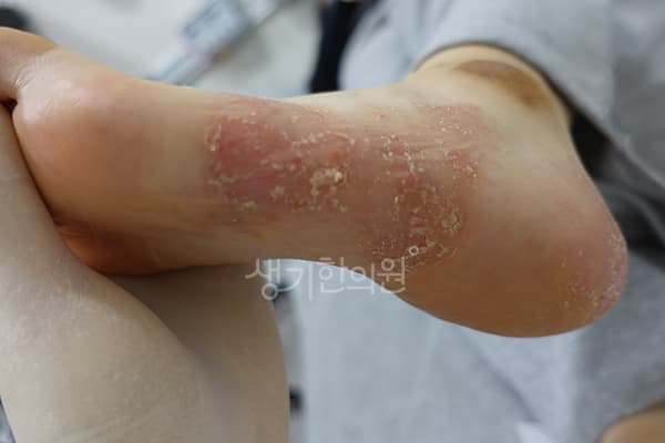 한포진 치료 전 사진 — 광주점, 치료 기간 4개월