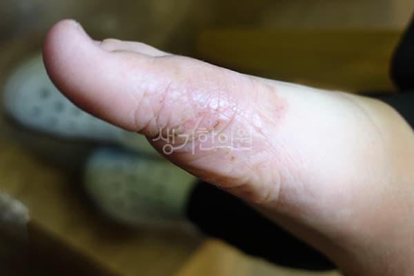 한포진 치료 전 사진 — 일산점, 치료 기간 3개월