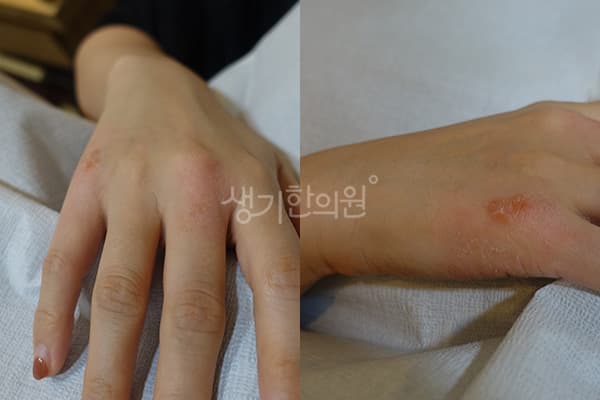 한포진 치료 전 사진 — 일산점, 치료 기간 8개월