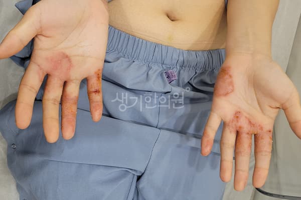 한포진 치료 전 사진 — 마포공덕점, 치료 기간 6개월