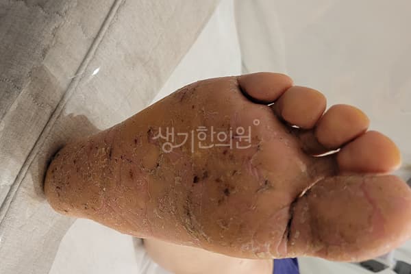 한포진 치료 전 사진 — 마포공덕점, 치료 기간 6개월