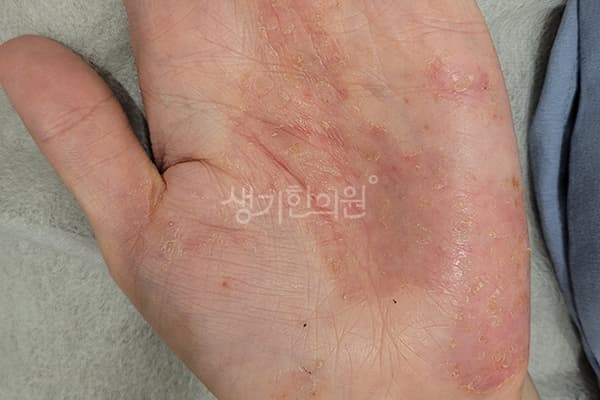 한포진 치료 전 사진 — 마포공덕점, 치료 기간 3개월
