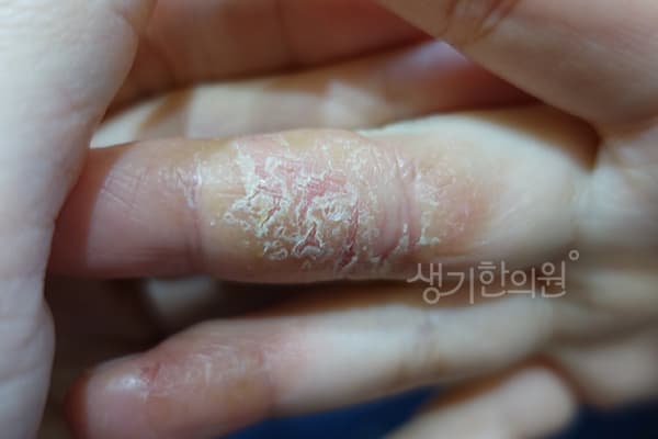 한포진 치료 전 사진 — 노원점, 치료 기간 4개월