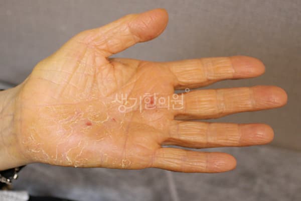 한포진 치료 전 사진 — 수원점, 치료 기간 9개월