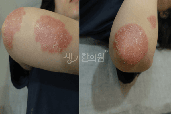 건선 치료 전 사진 — 부천점, 치료 기간 4개월