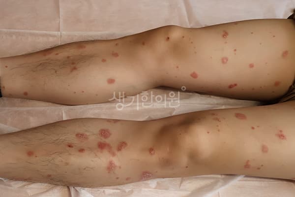 건선 치료 전 사진 — 분당점, 치료 기간 2개월