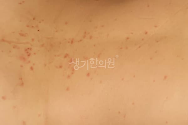 건선 치료 전 사진 — 분당점, 치료 기간 2개월