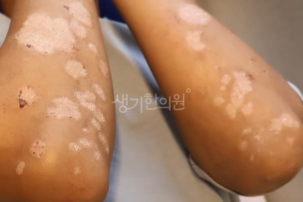 건선 치료 전 사진 — 분당점, 치료 기간 2개월