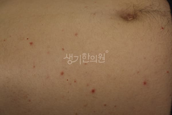 건선 치료 전 사진 — 부산서면점, 치료 기간 6개월