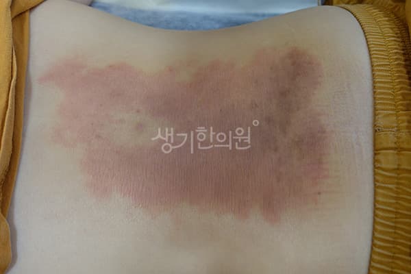 건선 치료 전 사진 — 일산점, 치료 기간 8개월