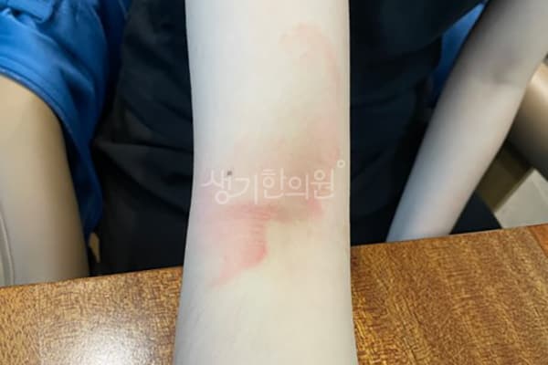 건선 치료 전 사진 — 잠실점, 치료 기간 5개월