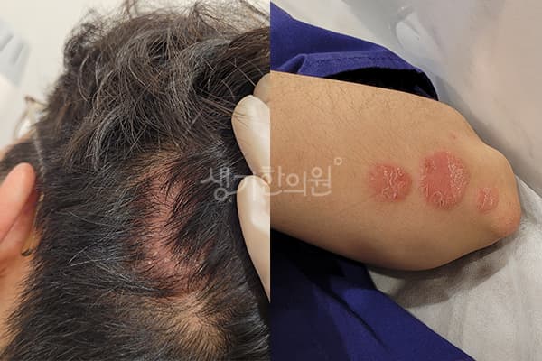 건선 치료 전 사진 — 마포공덕점, 치료 기간 17개월