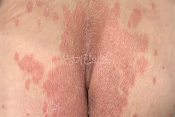 건선 치료 전 사진 — 신도림점, 치료 기간 4개월