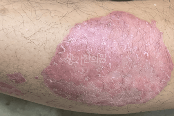 건선 치료 전 사진 — 신도림점, 치료 기간 9개월