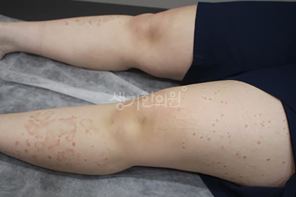 건선 치료 전 사진 — 수원점, 치료 기간 2개월