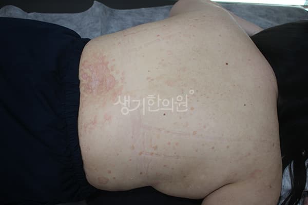 건선 치료 전 사진 — 수원점, 치료 기간 2개월