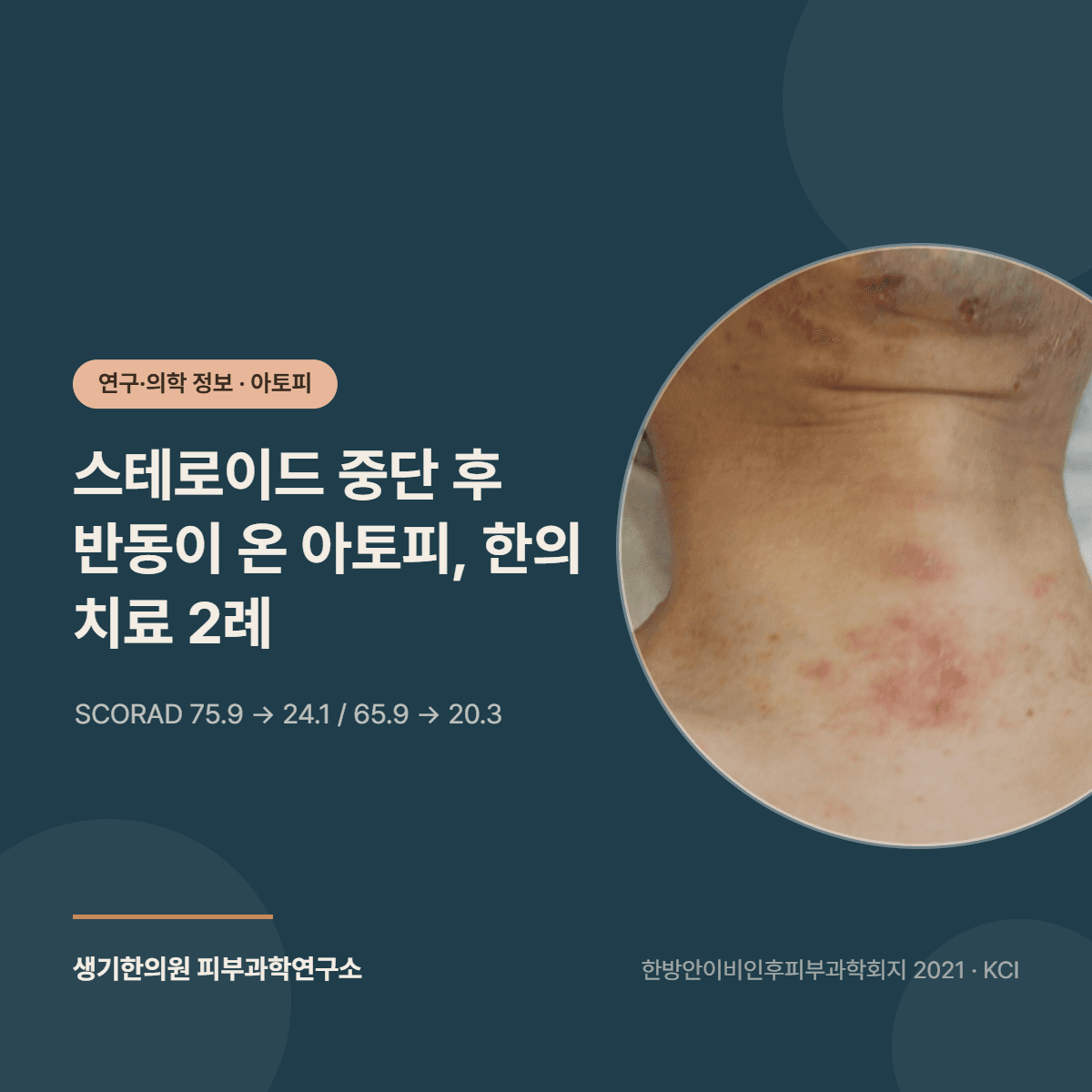 스테로이드 중단 후 반동 아토피 한의 치료 2례 연구 소개 대표 이미지