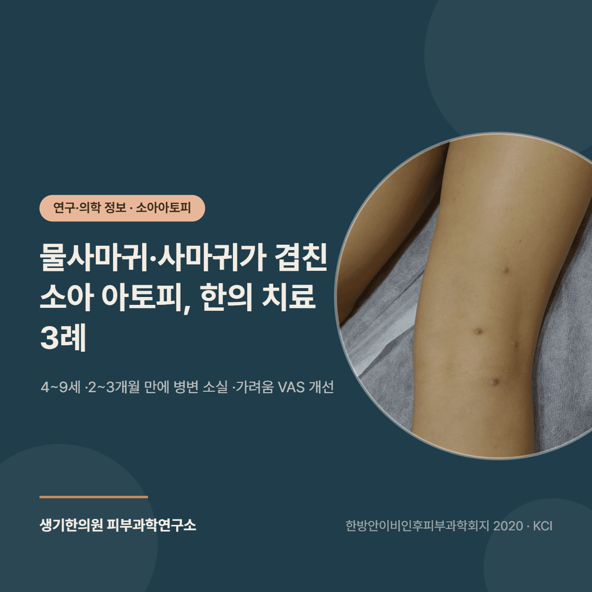 전염성 연속종과 보통 사마귀가 동반된 소아 아토피 피부염 3례 연구 소개 대표 이미지