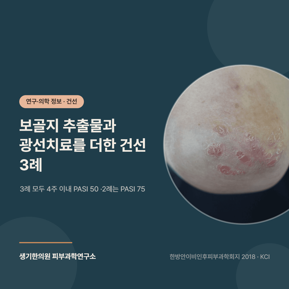 보골지 추출물을 병행한 건선 한방치험 3례 연구 소개 대표 이미지