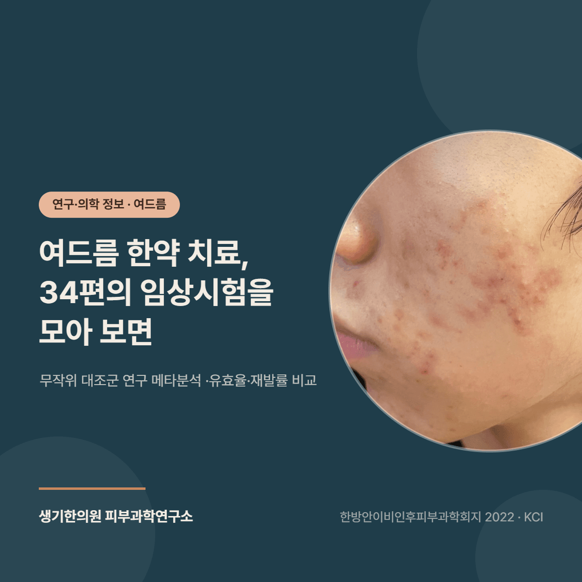 여드름 한약 치료 무작위 대조군 임상연구 메타분석 연구 소개 대표 이미지