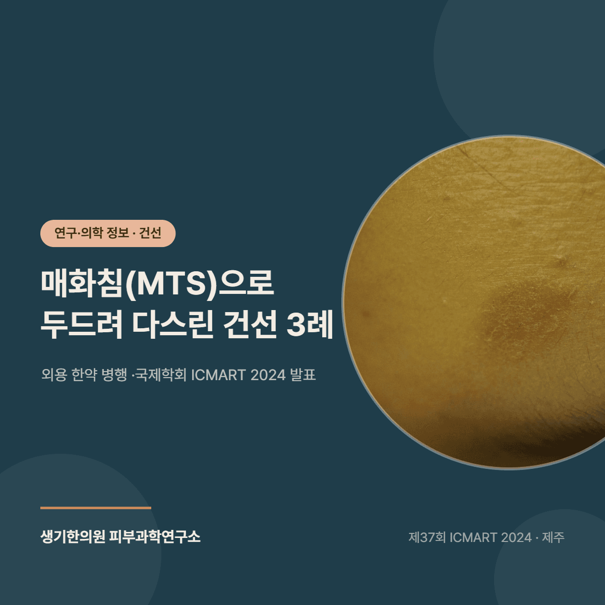 MTS(매화침)을 이용한 건선 한의 치료 3례 연구 소개 대표 이미지