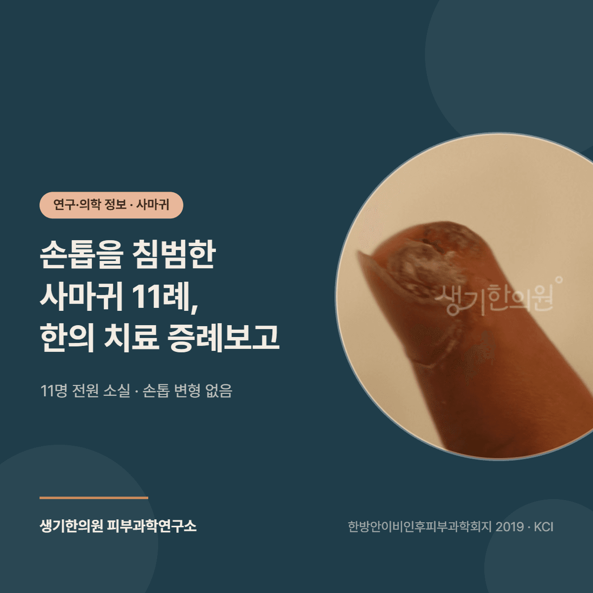 손톱 침범 사마귀 11례 한의 치료 증례보고 연구 소개 대표 이미지