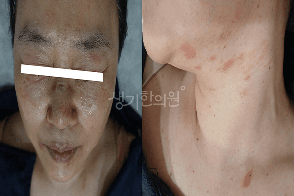 지루성피부염 치료 전 사진 — 부천점, 치료 기간 3개월