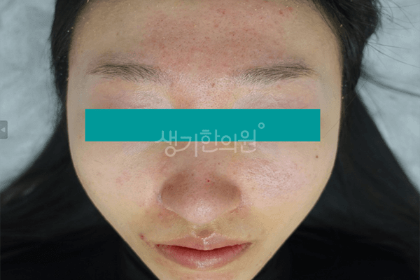 지루성피부염 치료 전 사진 — 부천점, 치료 기간 5개월