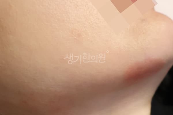 지루성피부염 치료 전 사진 — 분당점, 치료 기간 3개월