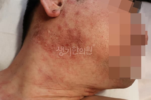 지루성피부염 치료 전 사진 — 분당점, 치료 기간 5개월