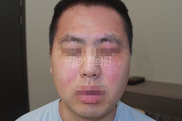 지루성피부염 치료 전 사진 — 천안아산점, 치료 기간 4개월