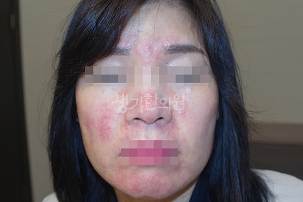 지루성피부염 치료 전 사진 — 천안아산점, 치료 기간 3개월