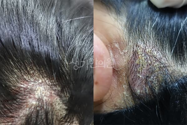지루성피부염 치료 전 사진 — 광주점, 치료 기간 4개월