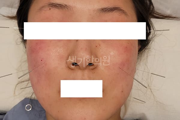 지루성피부염 치료 전 사진 — 마포공덕점, 치료 기간 6개월