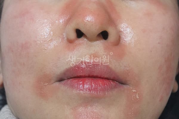 지루성피부염 치료 전 사진 — 수원점, 치료 기간 1개월