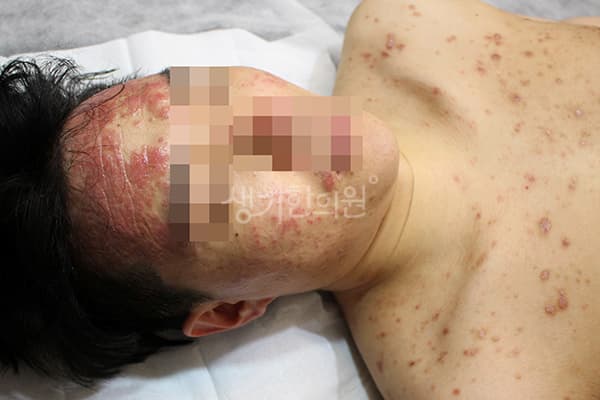 지루성피부염 치료 전 사진 — 수원점, 치료 기간 5개월
