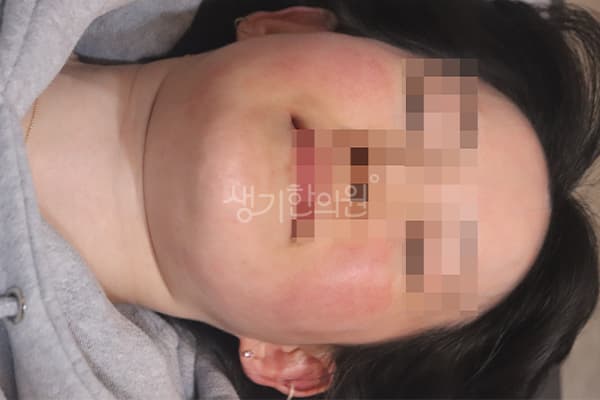 지루성피부염 치료 전 사진 — 수원점, 치료 기간 2주