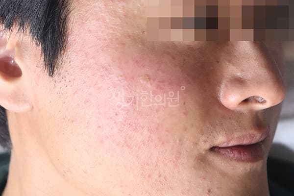 지루성피부염 치료 전 사진 — 수원점, 치료 기간 3개월