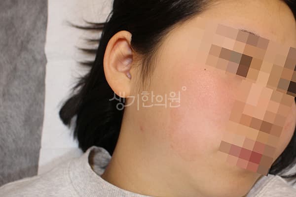 지루성피부염 치료 전 사진 — 수원점, 치료 기간 4개월