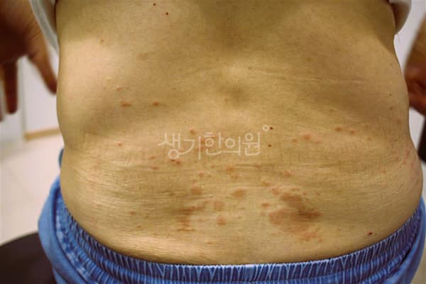 두드러기 치료 전 사진 — 안산점, 치료 기간 3개월