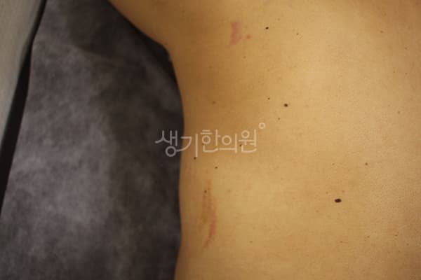 두드러기 치료 전 사진 — 안산점, 치료 기간 3개월