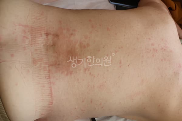 두드러기 치료 전 사진 — 분당점, 치료 기간 3개월