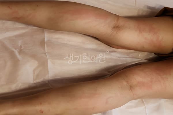 두드러기 치료 전 사진 — 분당점, 치료 기간 3개월