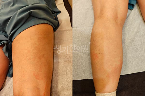 두드러기 치료 전 사진 — 부산센텀점, 치료 기간 3개월