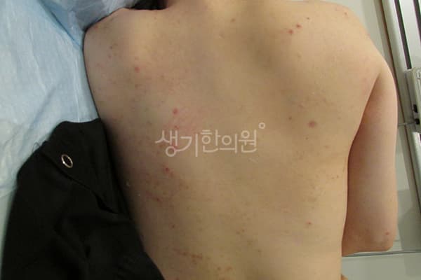 두드러기 치료 전 사진 — 부산서면점, 치료 기간 3개월