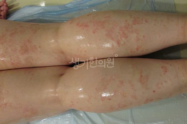 두드러기 치료 전 사진 — 부산서면점, 치료 기간 3개월