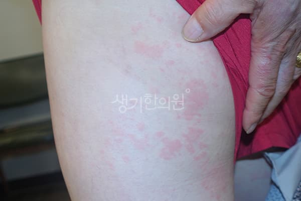 두드러기 치료 전 사진 — 천안아산점, 치료 기간 3개월