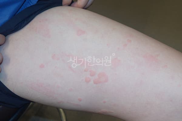 두드러기 치료 전 사진 — 천안아산점, 치료 기간 6개월