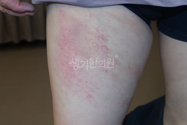 두드러기 치료 전 사진 — 천안아산점, 치료 기간 3개월